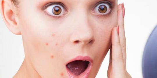 Cara menghilangkan bekas jerawat