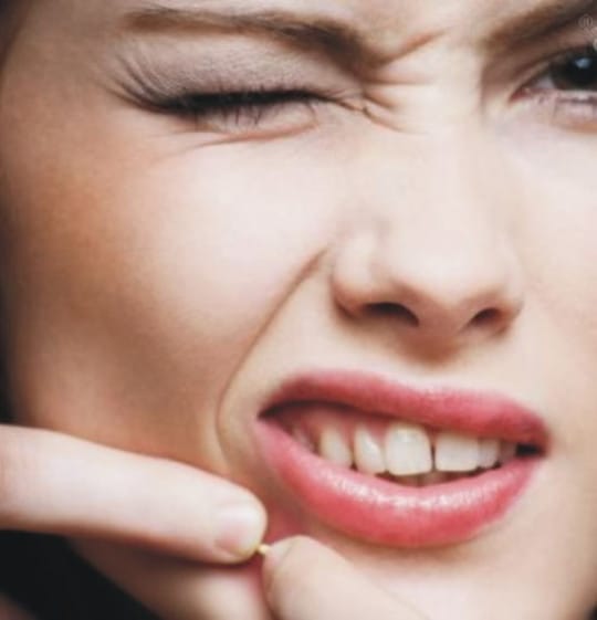 jerawat  pada saat hamil