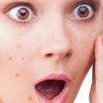 Cara menghilangkan bekas jerawat batu